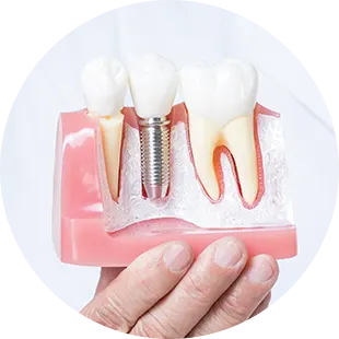 임플란트 책임보증제